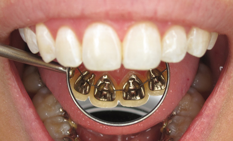 Görünmeyen Ortodonti (Diş Teli) Tedavisi - Lingual Ortodonti